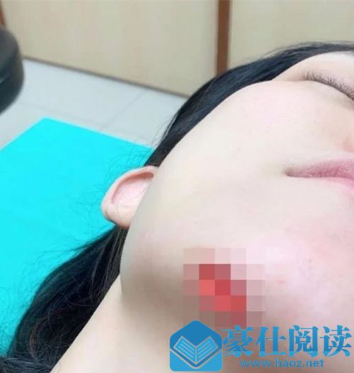 范玮琪下巴缝15针 这到底是什么情况？