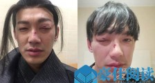 威廉拍戏出意外 背后原因令人敬佩又心疼