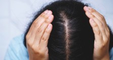 植发生意的难题:大多数人宁愿秃着