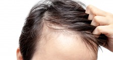 雍禾医疗冲击“植发第一股”:毛利率75% 、净利率10%,雷声大雨点小?