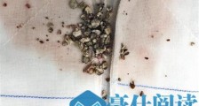 单侧输尿管堆满结石 6月大男婴怎么了?