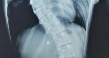 重庆12岁女童脊柱弯曲如“S型” 手术后终于“挺直腰杆”