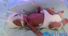 浙江宁波2斤早产女宝宝平安出院 出生时手臂如成人手指粗